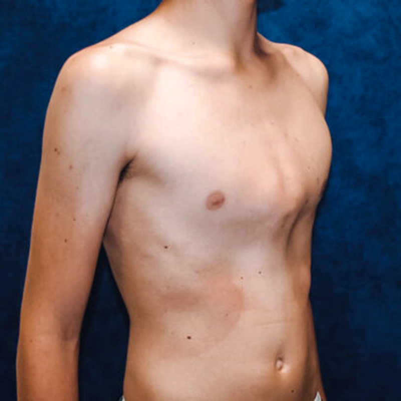 pectus carinatum